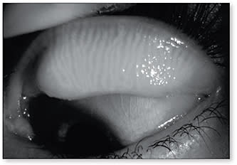 Figure 2. A normal meibography image of a subject who had a severe dry eye symptom score.