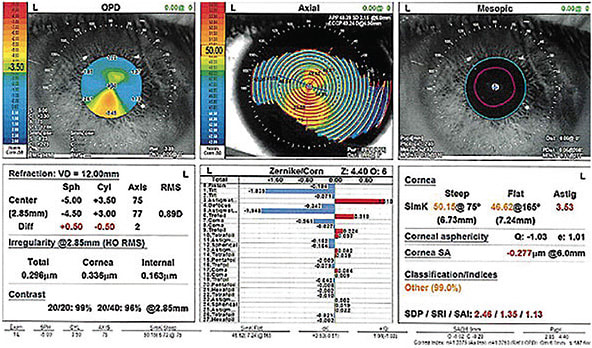 Figure 3. Lower- and higher-order aberrations contribute to decreased quality of vision.