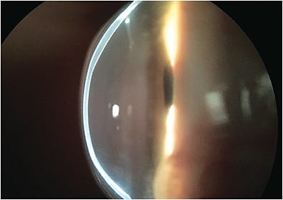 Figure 12. Profile view of a scleral lens vaulting a 28-year-old corneal transplant. Due to extremely complex geometry, all other contact lens options had failed. Transplanted tissue showed reduced endothelial cell count with significant polymegethism and pleomorphism. Prudent choices were made to reduce risk of complication by utilizing hyper-Dk material, reduced apical clearance, and reduced lens thickness while promoting tear exchange. The patient is followed every three months.