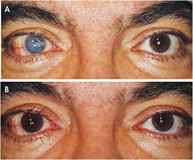 Figure 8. Traumatic injury presented with secondary glaucoma and corneal transplant complications before (A) and after (B) being fit with a prosthetic lens.