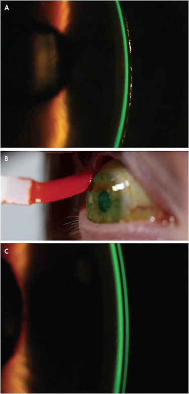 Figure 2. Fluorescein facilitates observation of lens surfaces for evaluation of lens vault. (A) Anterior surface of the lens is not clearly visible. (B) Wipe the anterior surface with the fluorescein strip. (C) After blinking, the fluorescein stains the entire anterior surface, facilitating assessment. (A and C) Observation is performed with white light, rotating the slit beam by approximately 45&amp;#xB0;. In this case, the post-lens fluid reservoir was also stained with fluorescein before lens application.