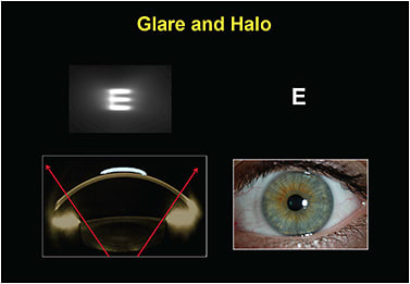 Figure 5. (Left) Significant glare and halos secondary to a large pupil size relative to the optic zone size. (Right) Glare minimized by smaller pupil size relative to optic zone.