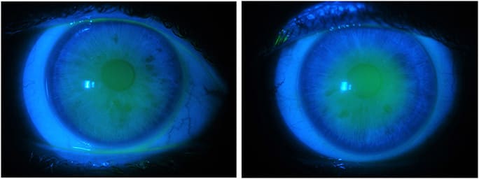 Figure 6. Fluorescein pattern of intralimbal GP lenses OD (left) and OS (right).