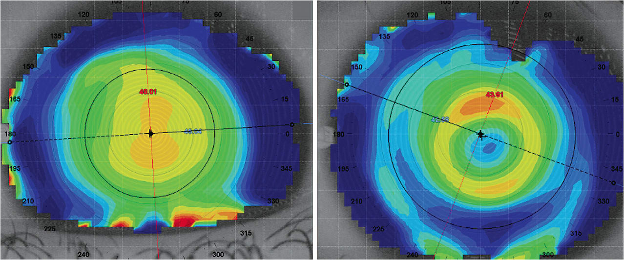 Figure 1. Topography of a myopic pediatric patient without a contact lens (left) and after a high-add soft multifocal is fitted for myopia control (right). Note the paracentral steeper bull’s-eye pattern indicating where the high add power of the multifocal is located (left).