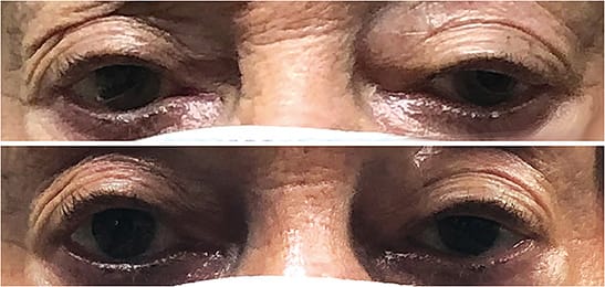 Figure 1. (Top) A patient before treatment with unilateral ptosis who wears rigid GP lenses. (Bottom) 15 minutes post-drop installation. The patient was treated with oxymetazoline 0.1% ophthalmic solution and achieved a good cosmetic result and better lens centration and comfort.Images courtesy of Dr. Resnick.