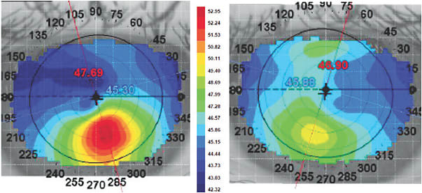 Figure 2. Topography of patient B demonstrates inferior steepening classic of keratoconus in the right eye (left), and the left eye shows irregular astigmatism with slight inferior steepening (right).