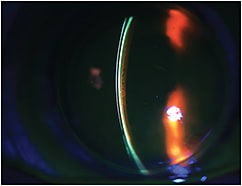 Figure 1. NaFl is placed inside the bowl of a hybrid lens and on the lens surface to easily visualize the GP lens thickness in relation to lens vault over the cornea.