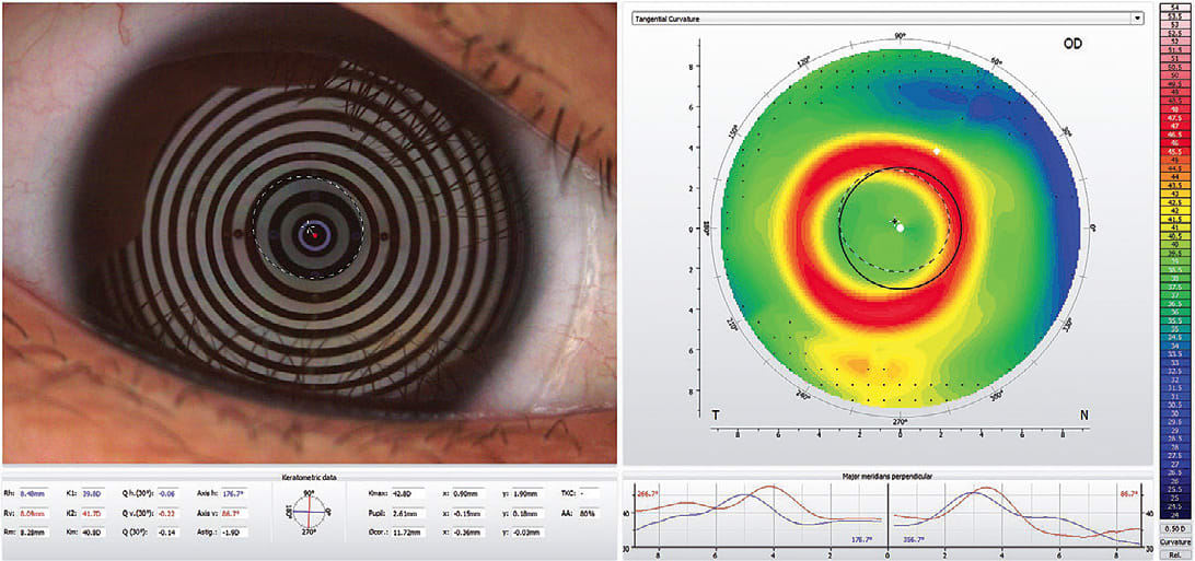 Figure 4. Corneal topography over the right lens of Case 3 patient demonstrating the ring of high plus power and adequate centration to provide good distance vision through the center of the lens.