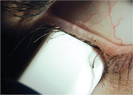 Figure 2. A calibrated pressure is being applied to the lower lid. Within the area of the meibomian gland evaluator, four glands are actively expressing oils. Image previously published in the July 2019 issue of CLS.