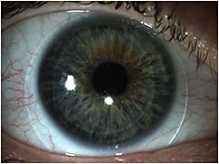 Figure 1. Lenses should be centered accurately at both initial fit and after hours of wear.