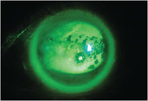 Figure 1. The Case 1 patient’s left eye exhibiting significant staining.