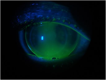 Figure 7. Intralimbal GP trial lens, note the bubbles at the lower lid.