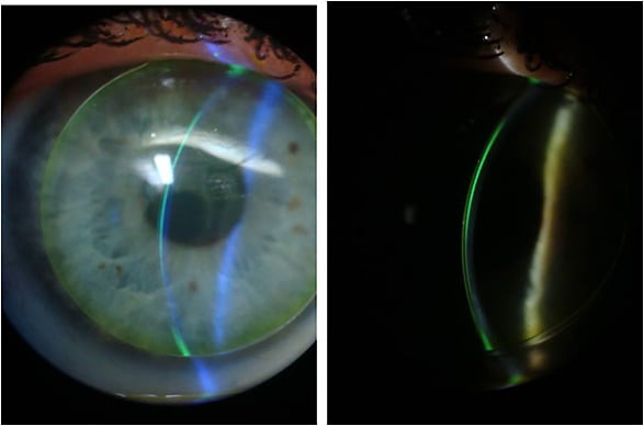 Figures 3 and 4. Slit lamp optic section view of the corneal GP fitting.