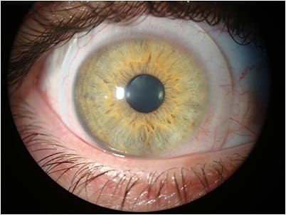 Figure 9. OD scleral lens fit after nine hours. The patient was happy with the result.