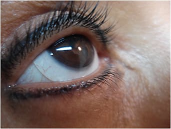Figure 2. The scleral lens fit as therapeutic and visual correction.