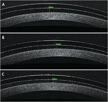 Figure 1. Tear clearance observed with OCT imaging after (A) five minutes, (B) two hours, and (C) eight hours of wear.