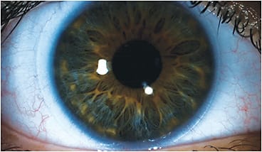 Figure 2. A right eye with keratometric values of 43.25/44.00 @ 090 fit with a soft spherical contact lens marked with an 8.6mm base curve and 14.0mm diameter.