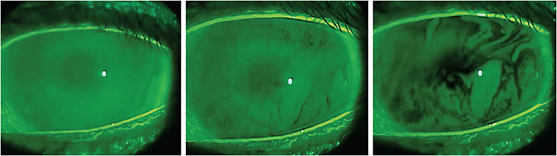 Figure 1 (Left) The tear film immediately after the blink is normal. (Center) The tear film one second after the blink already demonstrates breakup. (Right) The tear film after four seconds demonstrates severe irregularities.