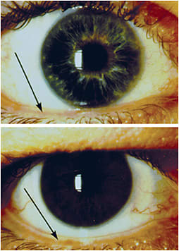 Figure 2. When the patient&#x2019;s lower lid is too far below the limbus, the lens will not be able to translate properly.