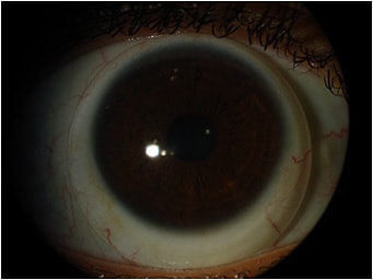 Figure 2. The 16.5mm scleral lens also decentered inferiorly.