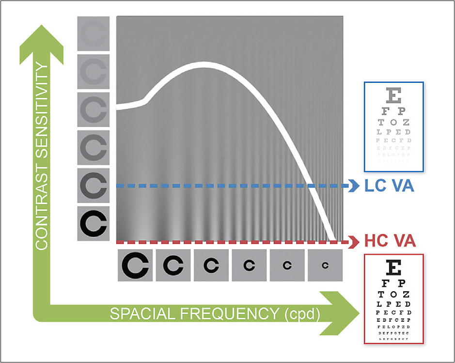 Figure 1. This represents a typical contrast sensitivity function (CSF). The area to the left of the CSF curve is more relevant in diseased eyes or low-vision patients. In the higher spatial frequency range, at the right end of the X axis, only higher-contrast images (Y axis values) can be perceived. Snellen VA testing during an exam for healthy individuals is typically performed at full contrast and with higher spatial frequencies, thus representing a point on the bottom right of the CSF curve. Including a low-contrast VA condition, indicated by the dotted blue line, can give another point on the curve, but the best information about overall visual quality is gained by deriving a more complete version of the CSF curve. Image used by permission from Adaptive Sensory Technology, Inc.