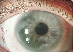 Figure 2. Large-diameter scleral lens on an eye with LSCD.