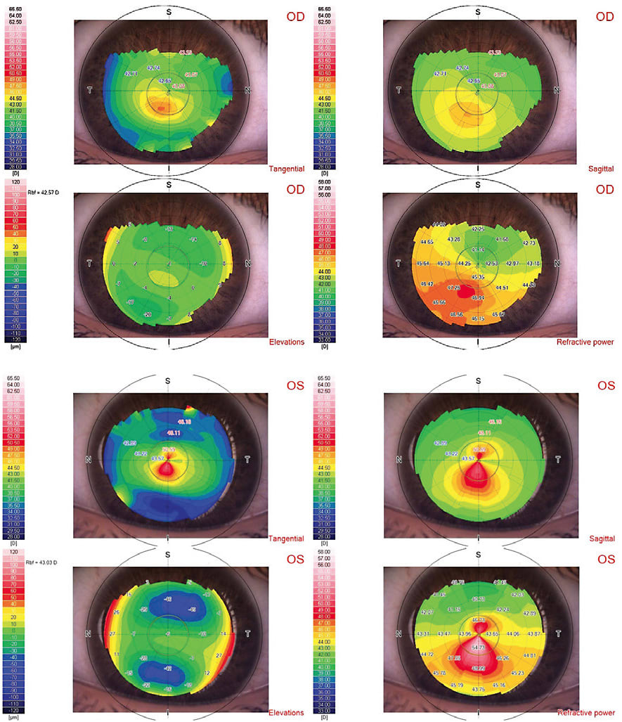Figure 1. Corneal topography with untreated KCN OD and s/p CXL OS.Image courtesy of Luis Rojas, OD