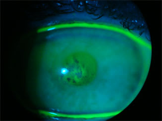 Figure 3. The erosion was healed, but damaged epithelium was still present.