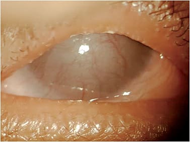 Figure 4. A patient who has SJS with severe corneal scarring, neovascularization, keratinization, and partial tarsorrhaphy.