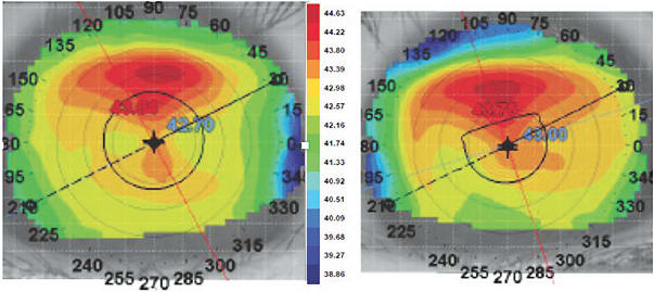 Figure 1. Topography of patient A depicts bilateral superior steepening.