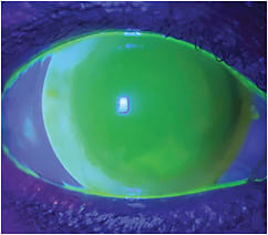 Figure 2. The steepest silicone hydrogel daily disposable lens was applied and successfully centered on the right scleral lens with perfect wetting.