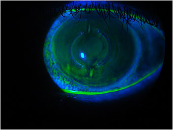 Figure 4. OS slit-lamp observation with fluorescein.