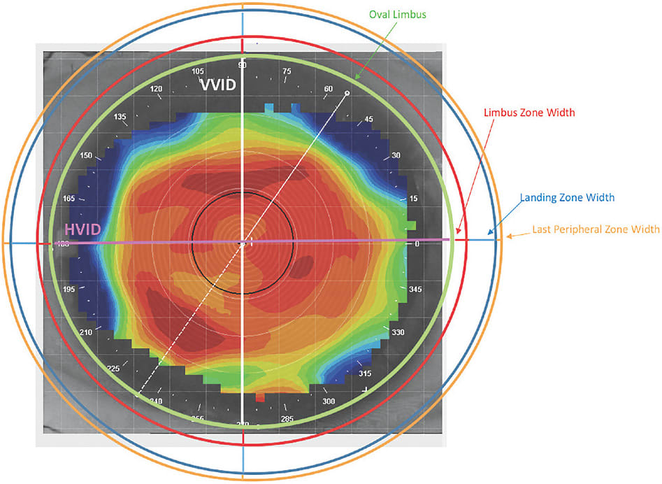 Figure 4. Illustration showing all of the zone diameters on an eye with an oval-shaped limbus. Only the HVID and the VVID values are different. The outer diameters are equidistant.