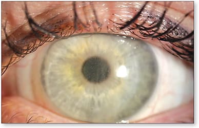 Figure 5. Post-lens tear fogging; wide view Courtesy of Dr. Jason Jedlicka