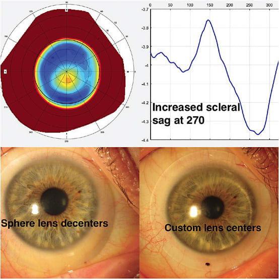 Figure 2. A highly asymmetric sclera that has a relative increased sagittal height along the same axis as the corneal apex.