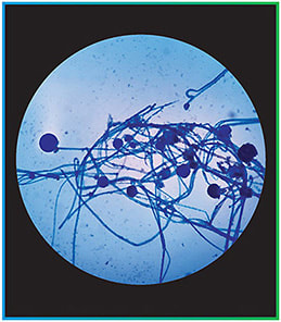 Figure 1B. Lactophenol cotton blue wet mount showing hyphae and fruiting bodies. Image courtesy of Tribhuvan University Teaching Hospital, Nepal