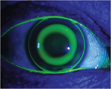 Figure 1. Fluorescein pattern of a well-fit ortho-k lens.