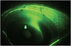 Figure 2. Fluorescein rapidly entering under the superior haptic of the scleral lens.