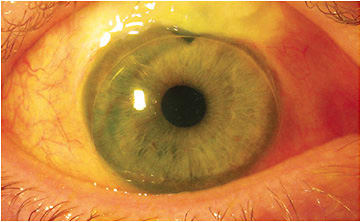 Figure 1. A corneal GP lens for an eye with a large conjunctival bleb that overhangs the limbus.