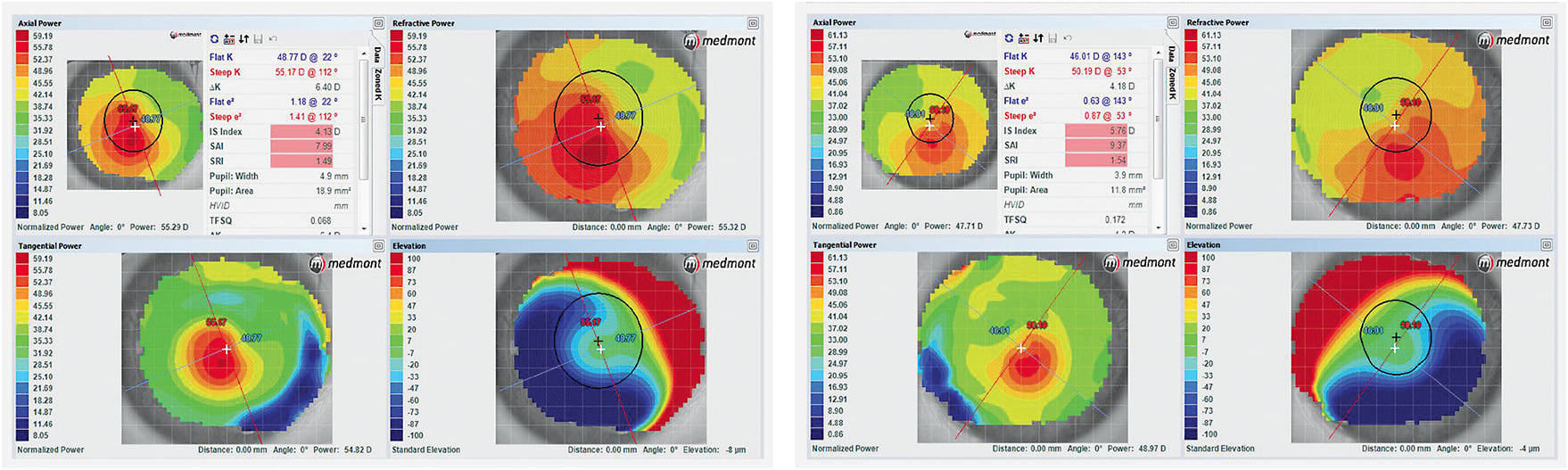 Figure 1. (left image) Corneal topography of right eye and (right image) of the left eye.