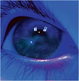 Figure 1. Patient fit with a scleral lens to promote healing of her cornea.