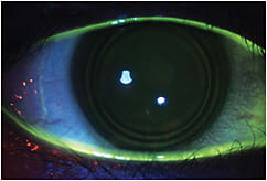 Figure 3. When a hybrid lens skirt is fit too steep, the lens can seal off on the surface of the eye, and tear exchange ceases. This can leave characteristic ring patterns on the surface of the cornea that show where the hybrid lens was sitting.