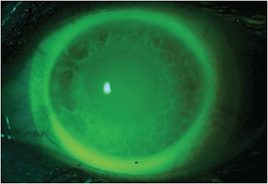 Figure 2. Scleral lens on eye with fluorescein and Wratten filter demonstrating limbal clearance 360º around as evidenced by fluorescein over that region.