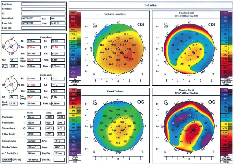 Figure 3. Corneal surface imaging is an important tool for fitting and monitoring patients who have irregular corneas. This keratoconus patient’s corneal tomography maps illustrate front-surface elevation, back-surface elevation, front-surface sagittal curvature, and corneal thickness.