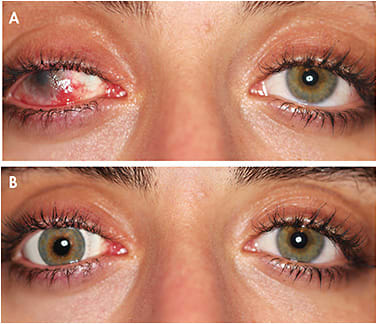 Figure 6. (A) shows glaucoma complications and corneal transplant complications prior to being fit with a hand-painted soft prosthetic scleral lens design (B).