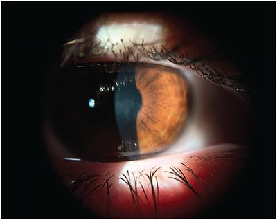 Figure 2A. Corneal scarring in a keratoconus patient.