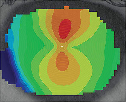 Figure 2. Topographical map of the patient’s left cornea.