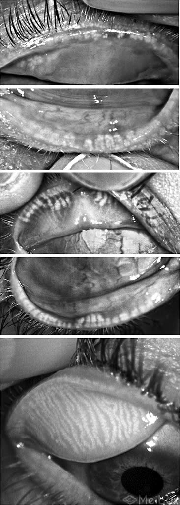 Figure 2. These are example meibography images, each taken with a different commercially available meibographer. The top and middle images show severe meibomian gland atrophy of both eyelids. The bottom image, taken with a newer meibographer, shows normal meibomian gland morphology of the upper eyelid. Bottom image courtesy of Box Medical Solutions