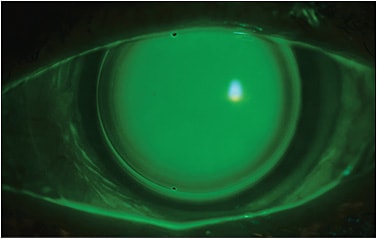 Figure 4. Optimal 100-micron central clearance of a hybrid lens on a keratoconic eye. The sodium fluorescein pattern is even throughout the central portion of the lens, and there is feather touch inside the junction of GP and soft as the GP portion lands on the peripheral cornea. Also visible is edge lift of the GP portion and bearing of the soft skirt more peripherally.