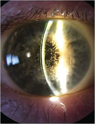 Figure 4. A scleral lens on an eye with granular corneal dystrophy.